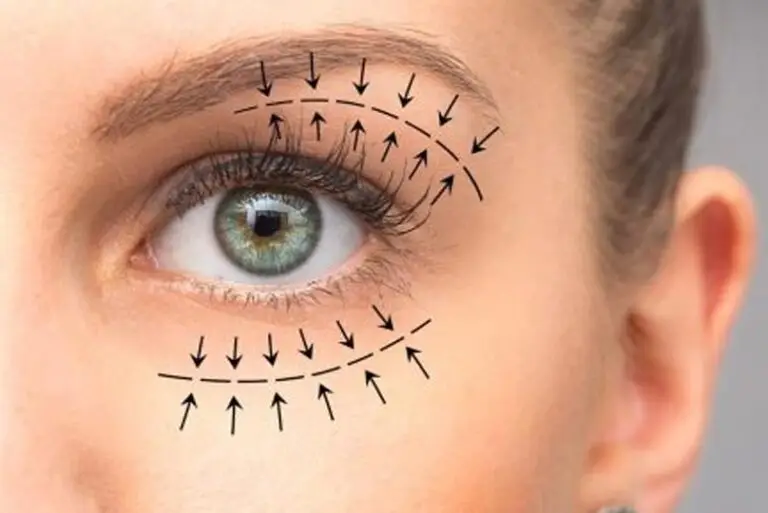 Blefaroplastia
