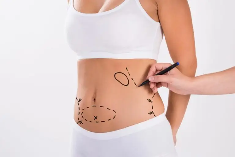 Lipoaspiração