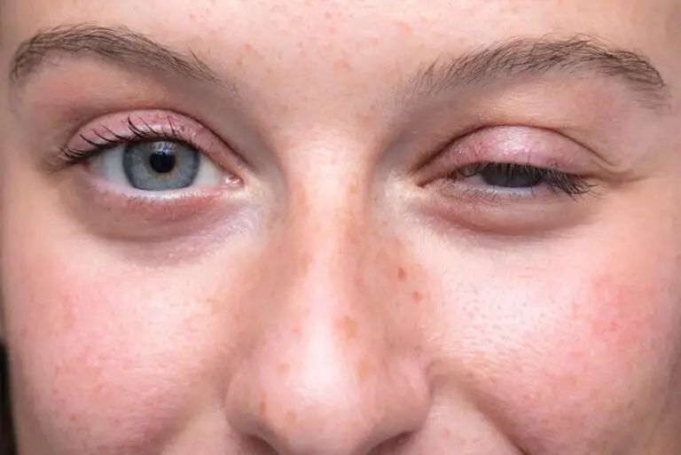 Ptose Palpebral